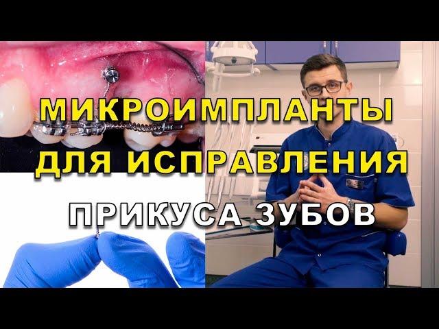 Исправление прикуса микро имплантами и брекетами. Ортодонты Люми-Дент в Киеве