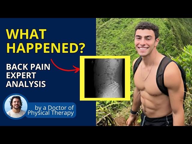 Luigi Mangione's Spine - A Back Pain Expert Analysis