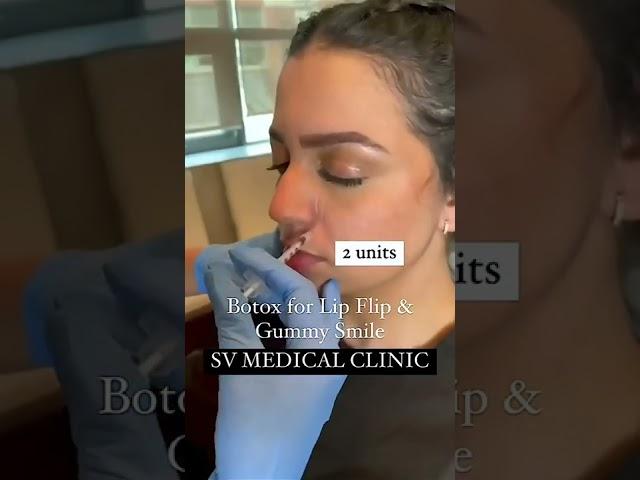 BOTOX Results: Quick, Easy Solution for Gummy Smile and Lip Flip | Skin Vitality Medical Clinic