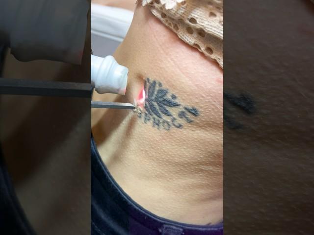 Удаляем тату - СЕРНОСТЬ  removing the tattoo #tattoo #tattooremoval #top #удалениетату