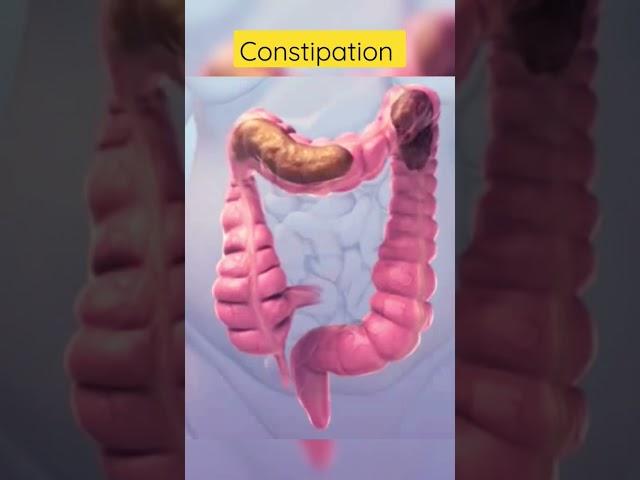 This is how constipation looks inside #viral #shortsvideo