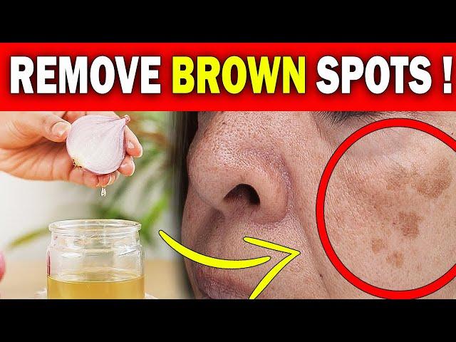 Effective Brown Age Spot Remedy - * FIX * THAT WORKS!