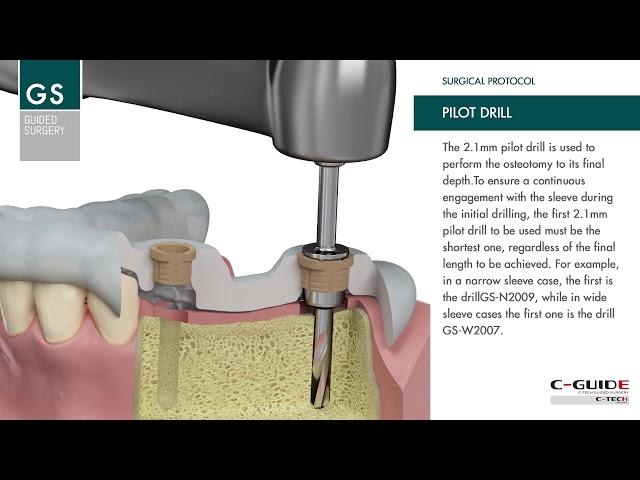 IT9+0:00 / 1:25C-TECH Guided Surgery: Surgical protocol