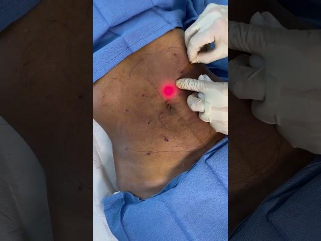 Endolift tx on the Abdomen to Melt Small Pockets of Stubborn Fat & Tighten the Skin - Ageless MD