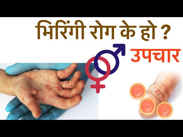 सिफलिस रोग/भिरिंगी रोग/syphilis/karan, upachar, test, aushadhi/viringi rog in nepali.