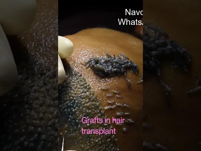 9416500112,  HD Live Hair transplant Implantation | Hair Graft looks