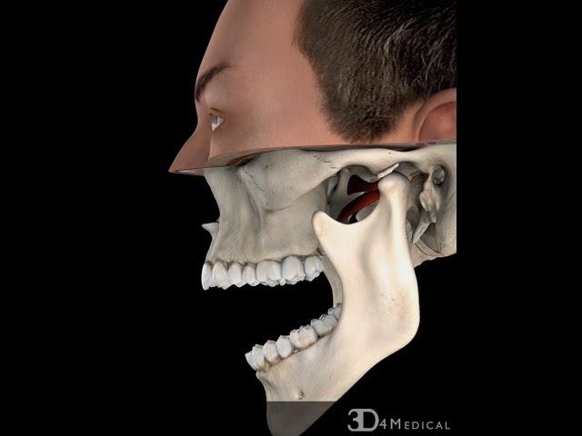 TMJ, with Reduction