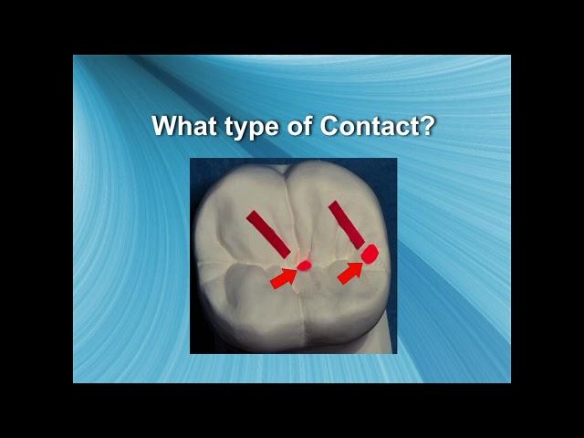 Setting Posterior Denture Teeth (Narrated Presentation)