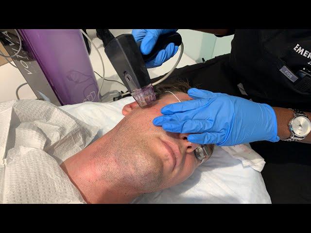 KEEP YOUR JAWLINE SNATCHED AND SKIN TIGHT WITH MORPHEUS 8 DEEP MICRONEEDLING RF | Dr. Jason Emer