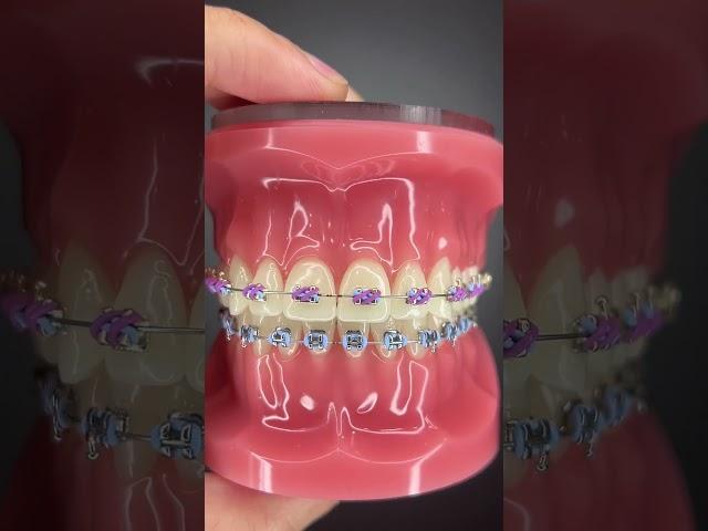 Different Types of Orthodontic Ties you can get at your Orthodontist Part 2