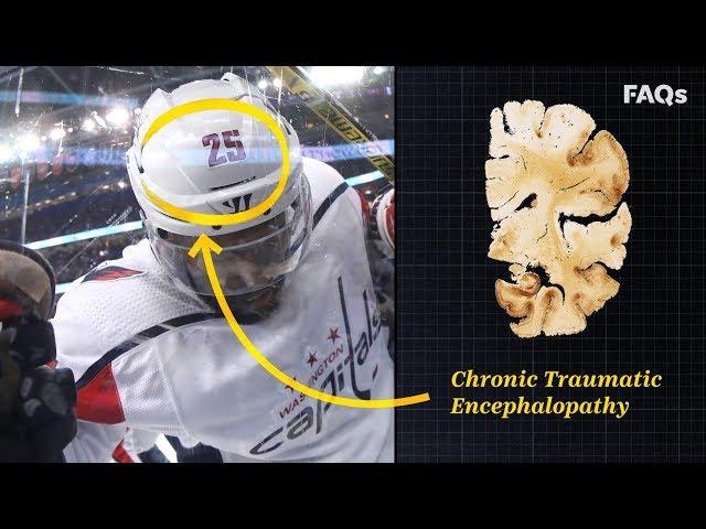 CTE: Why this brain disease is more common than you think