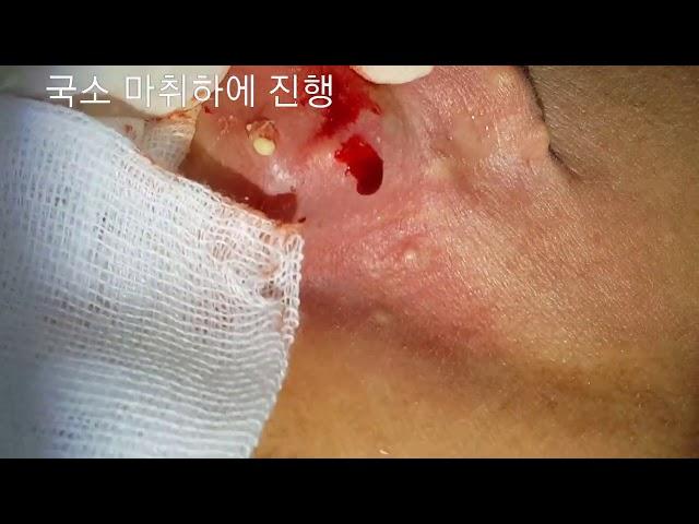 피지낭종 , 표피낭종 steatocystoma  not infected