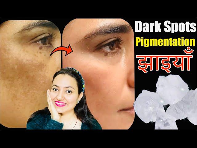 फिटकरी (Alum) से मुश्किल झाइयाँ Hyperpigmentation Melasma काले धब्बे Dark Spots का करें 100% इलाज