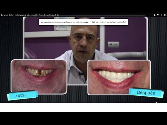 Dr. Ismael Soriano  Implantes con dientes inmediatos  Formación en Implantología