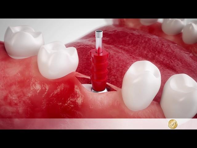 Implantology: Your way to firmly attached dental implants - full course of treatmen