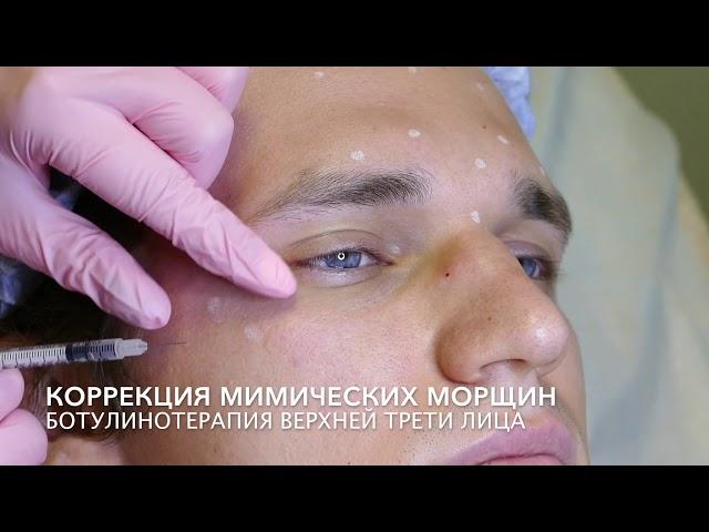 Ботулинотерапия верхней трети лица