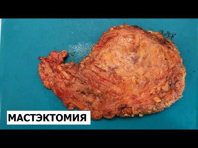 Рак молочной железы (радикальная мастэктомия) - гистологическое исследование (вырезка)