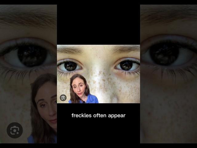 Freckles vs Age Spots #dermatologist @DrDrayzday