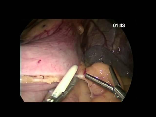 Laparoscopic Sleeve Gastrectomy with Caiman 5