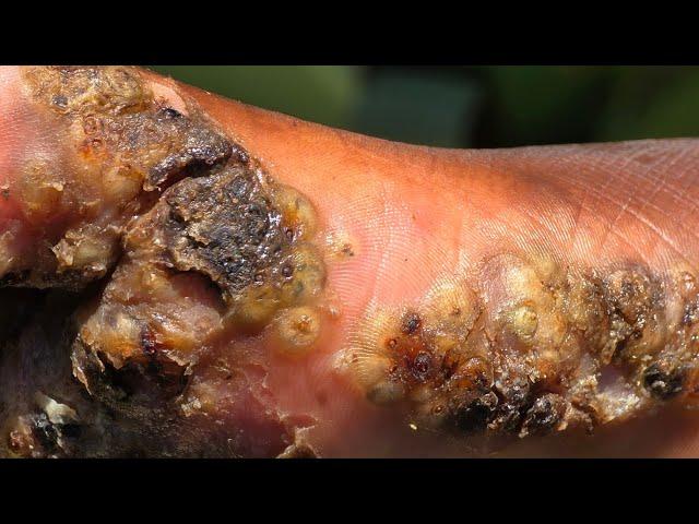Cosmas' jigger removal -  2nd MOST JIGGERED #1 --- long videos @riseupsociety.net & @ruskenya.org