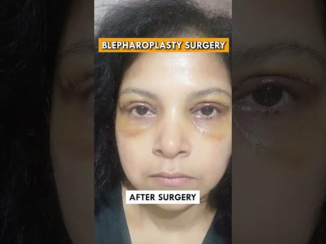 Get rid of puffy eyes today - Blepharoplasty surgery in Delhi! #blepharoplasty #puffyeyes #eyebags