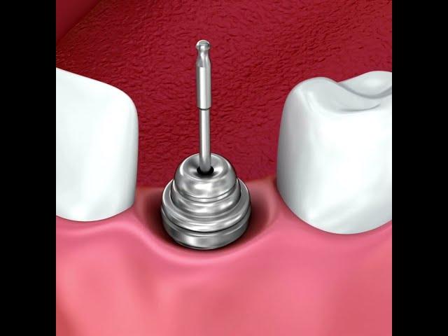 Dental Implant Procedure Explained Step by StepDental implant placement is a surgical procedure  #fu