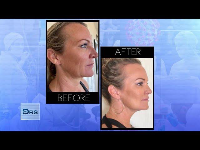 Watch This Instant Cheek Lift Using Only Thread