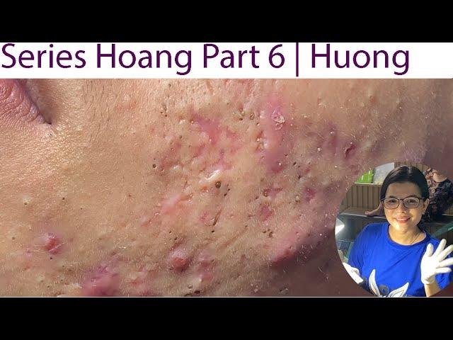 Acne Treatment Huong Da Nang# 023 | Series 6 Hoang  Loyal fans