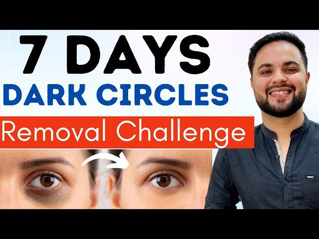 7 Days Dark Circles Removal Challenge || Permanent Treatment