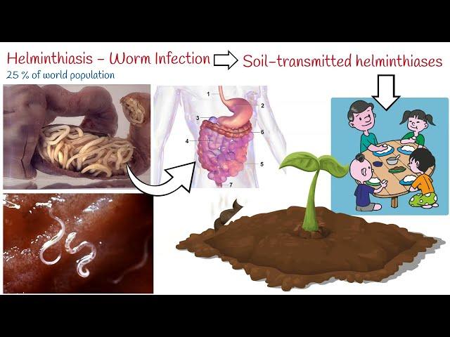 Helminthiasis - 3 Most Common Parasitic Worms:  Ascaris; Whipworm; Hookworm