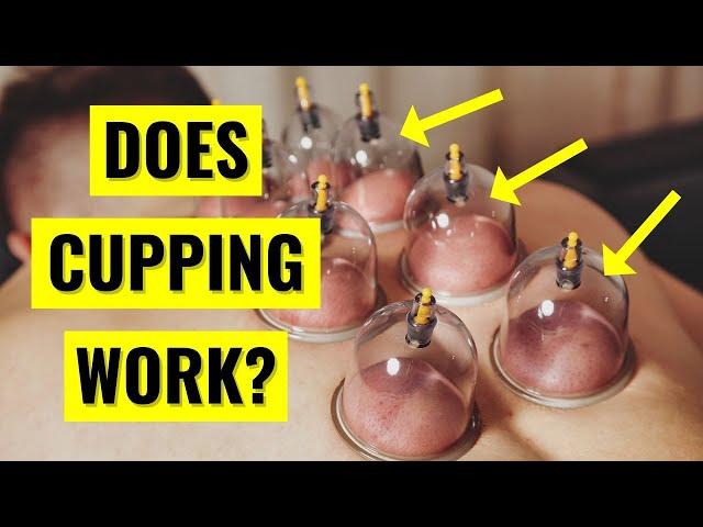 Does Cupping Therapy ACTUALLY Work?