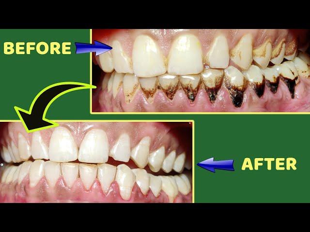 tambaku ke dant kaise saaf karen | teeth tobacco stain removal #shorts