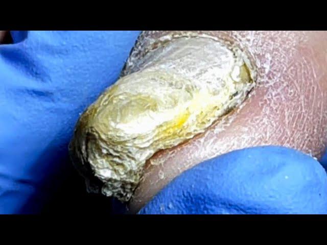 Trim Thick Onychomycosis Step By Step!【Pedicure Master Lin Jun】