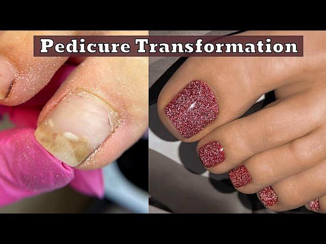 Ingrown Toenail Pedicure Satisfying Nail Cleaning 