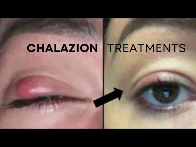 Chalazion Treatments: No-Cut NICE Therapy @GulaniVision