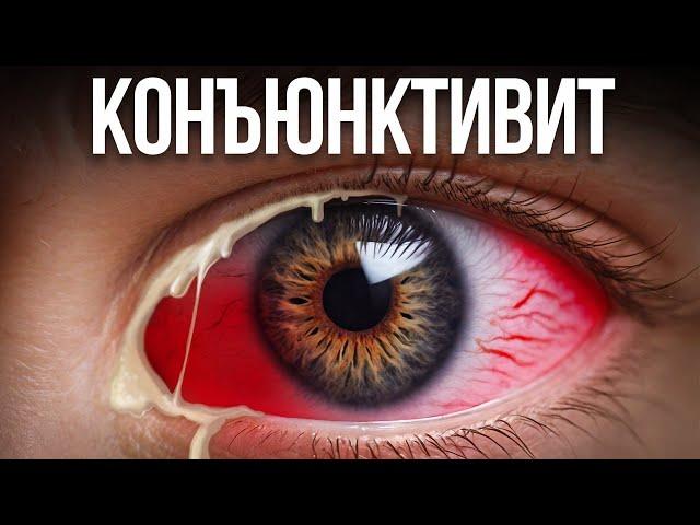 Красные глаза, конъюнктивит лечение!  Как вылечить КОНЪЮКТИВИТ за 1 день без медикаментов?