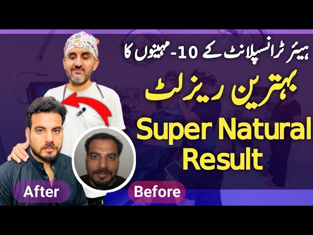 Hair Transplant 10-Months Live Result || Hair Transplant Perfect Result || Dr. Habib