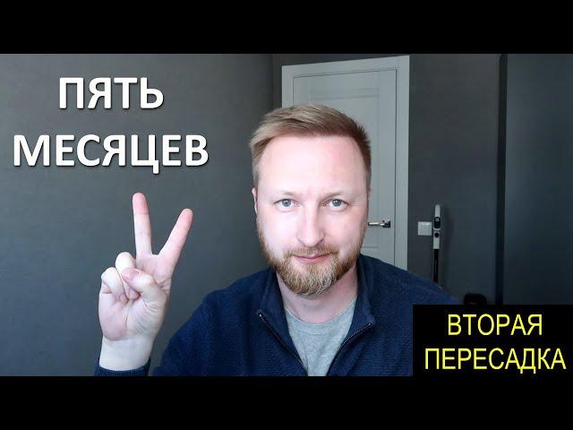 5 МЕСЯЦЕВ ПОСЛЕ 2 ПЕРЕСАДКИ