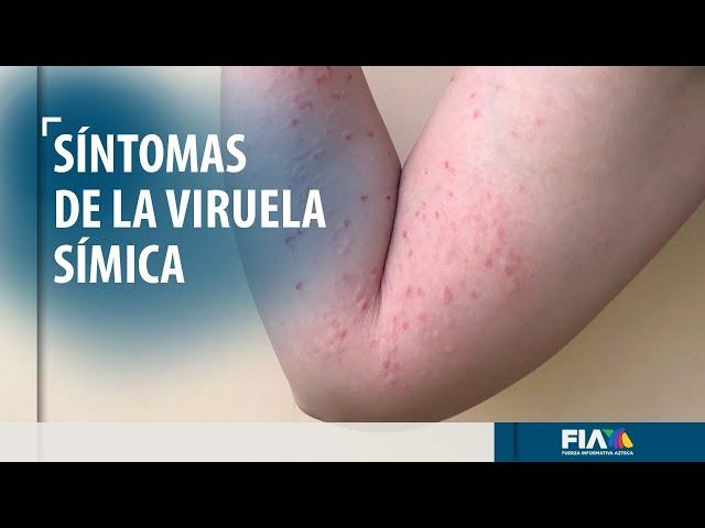 Viruela símica, síntomas y formas de contagio