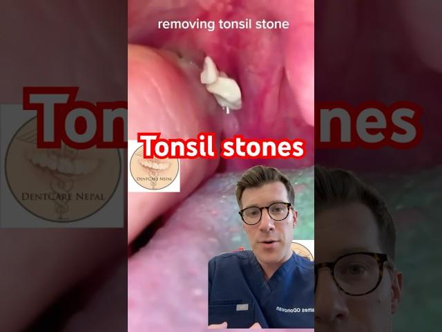 Removing tonsil stones #shorts