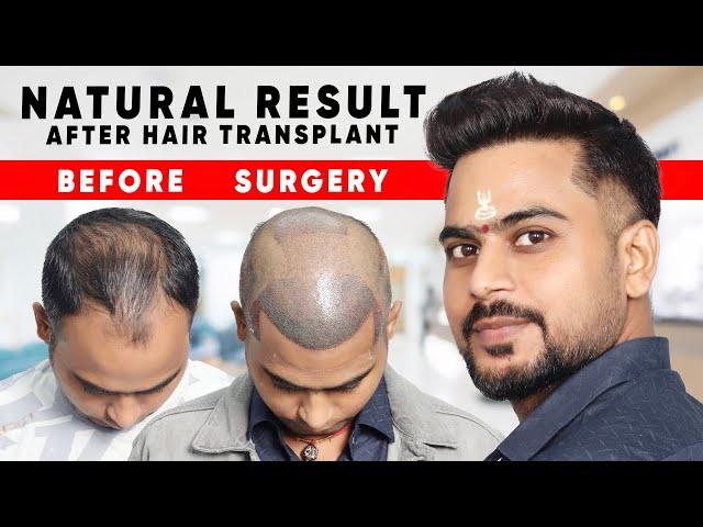 Classic Hair Transplant Result | Natural Hairline with High density Hair Transplant Result