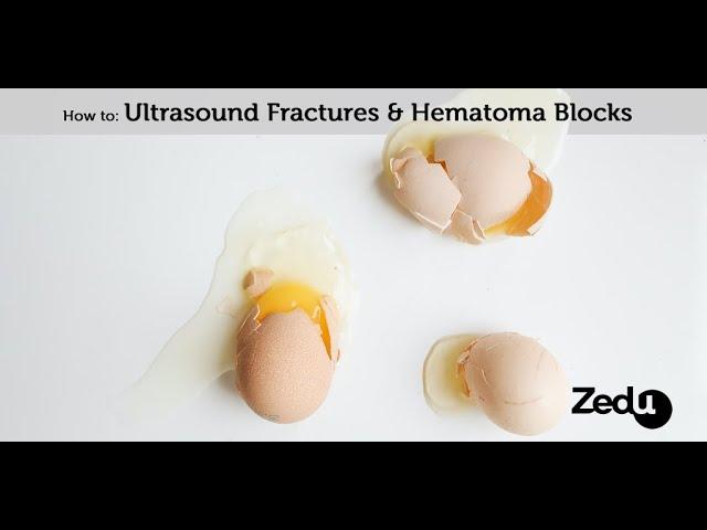 How to: Ultrasound fractures and hematoma blocks - Zedu POCUS Coaching Corner - 3 December 2020