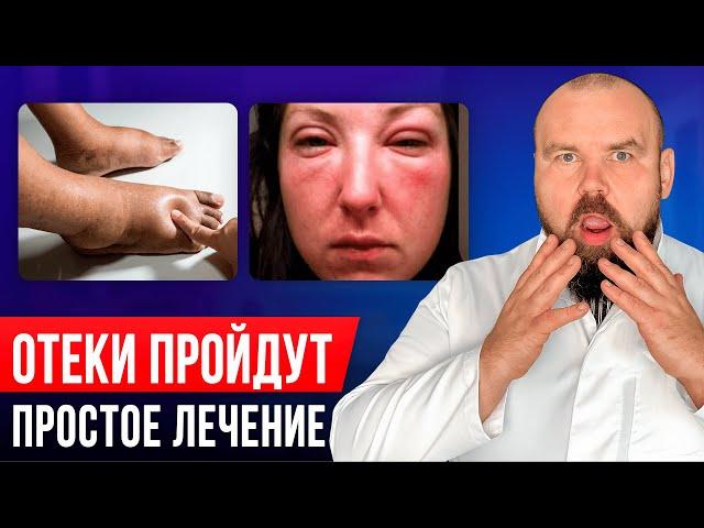 Избавиться от отеков НАВСЕГДА! Как вылечить отеки без лекарств и врачей