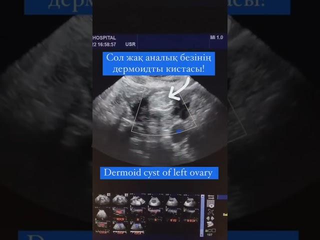 Аналык без кистасы