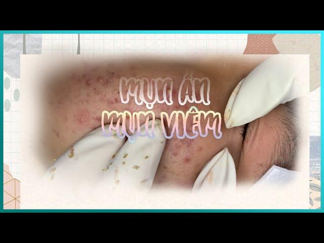 Big Cystic Acne Blackheads Extraction Blackheads & Milia, Whiteheads Removal Pimple Popping