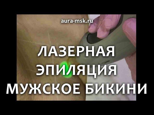 Лазерная эпиляция зоны бикини (мужчинам) в салоне красоты Аура эстетики