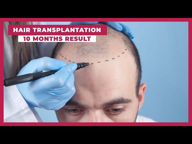 Sapphire Fue Hair Transplant 10 Months Results