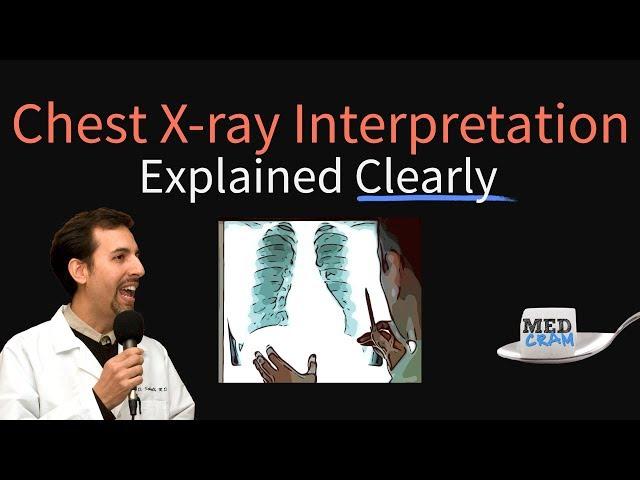 Chest X-Ray Interpretation Explained Clearly - How to read a CXR