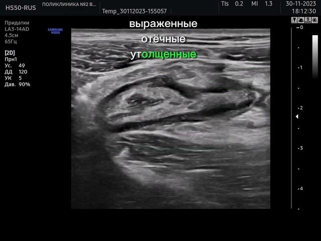 Острый аппендицит на УЗИ.