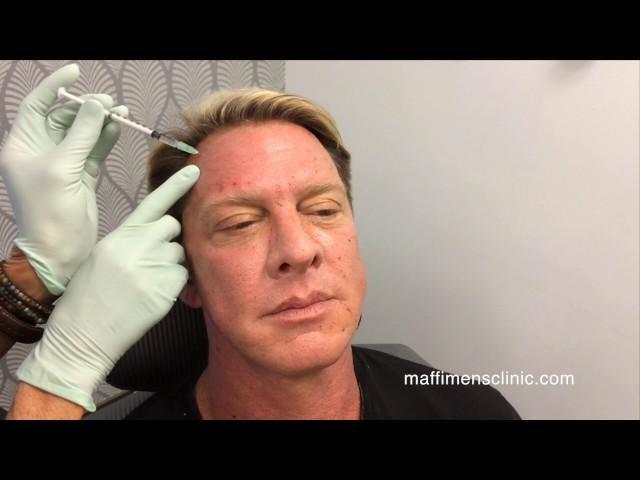 Maffi Clinics: Botox for Men